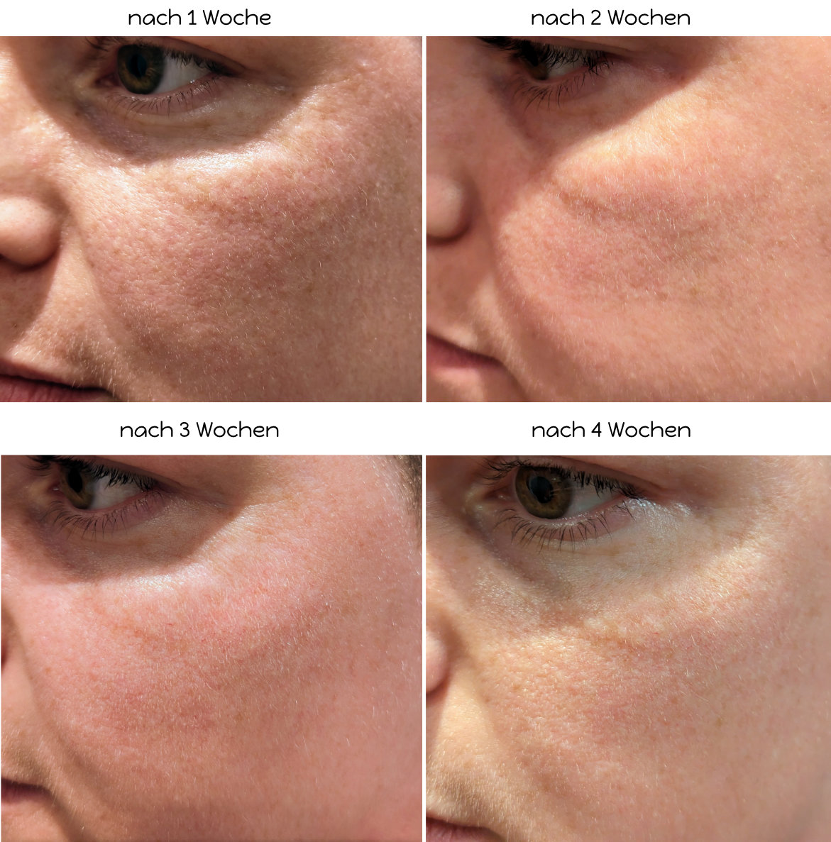 LED Lichttherapie-Maske von Koanna - Ergebnisse linkes Auge und Umgebung